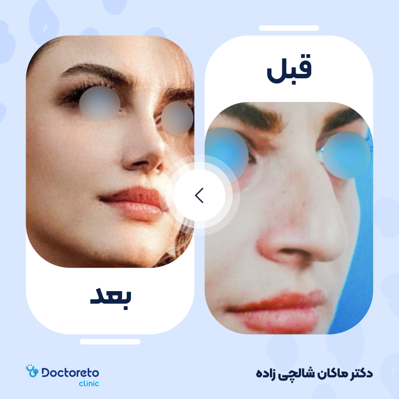 عمل زیبایی بینی (رینوپلاستی) دکتر ماکان شالچی زاده در رشت 6