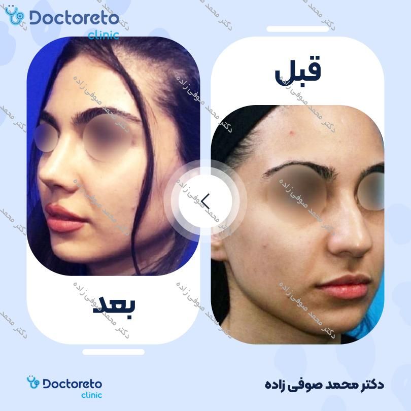جراحی انحراف بینی (سپتوپلاستی) دکتر محمد صوفی زاده در تهران 40