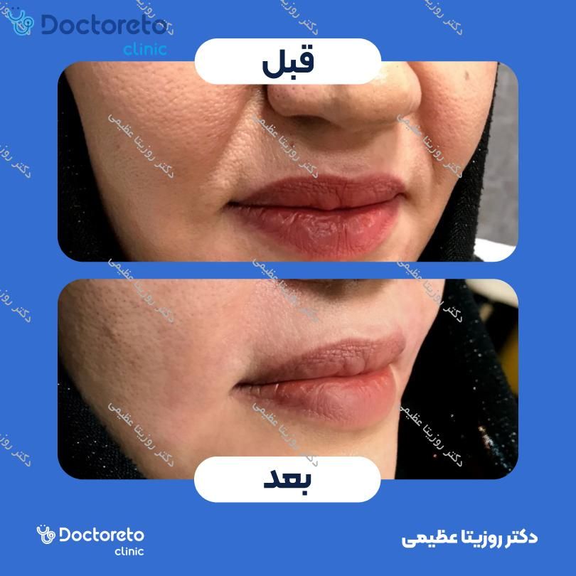 تزریق ژل خط خنده با برند نئوویا (1CC) دکتر روزیتا عظیمی در کرج 2