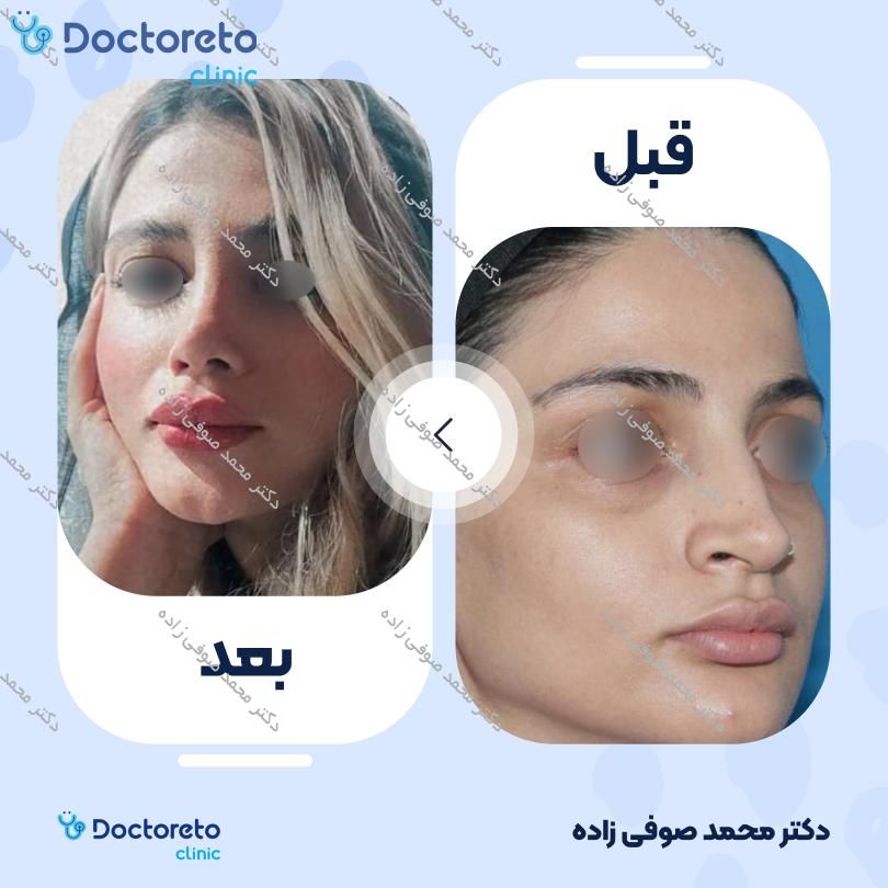 عمل جراحی مجدد زیبایی بینی (رینوپلاستی) دکتر محمد صوفی زاده در تهران 25