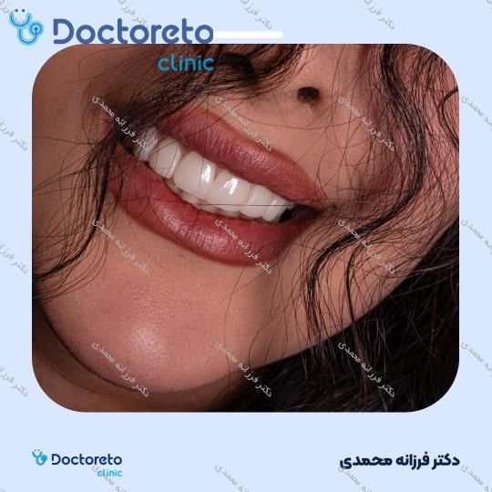 ونیر کامپوزیت توکویاما ژاپنی (هر واحد) دکتر فرزانه محمدی در شیراز 2