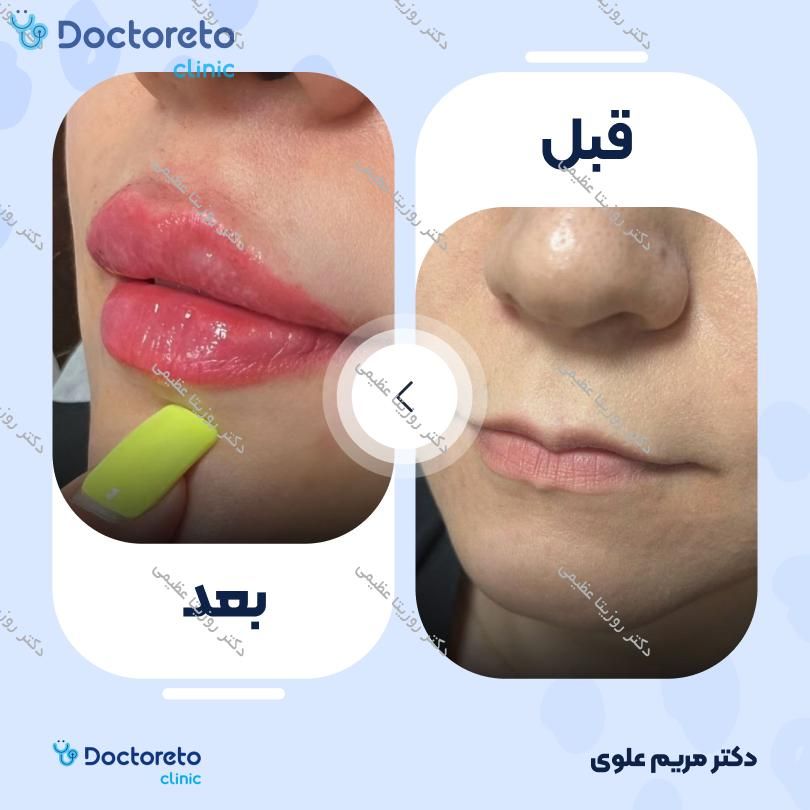 تزریق ژل لب با برند نوکسیول (1CC)