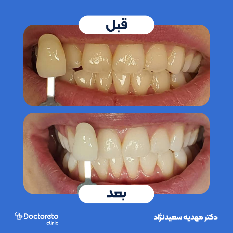 آفیس بلیچینگ با مواد الترادنت آمریکایی (هر فک) دکتر مهدیه سعیدنژاد در تهران 4