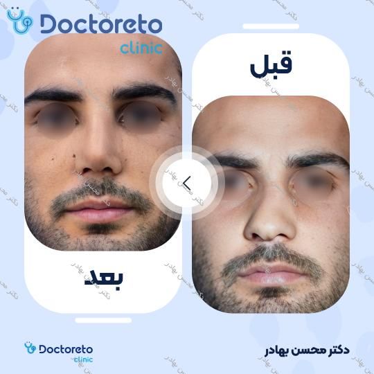 جراحی انحراف بینی (سپتوپلاستی) دکتر محسن بهادر در مرودشت 6