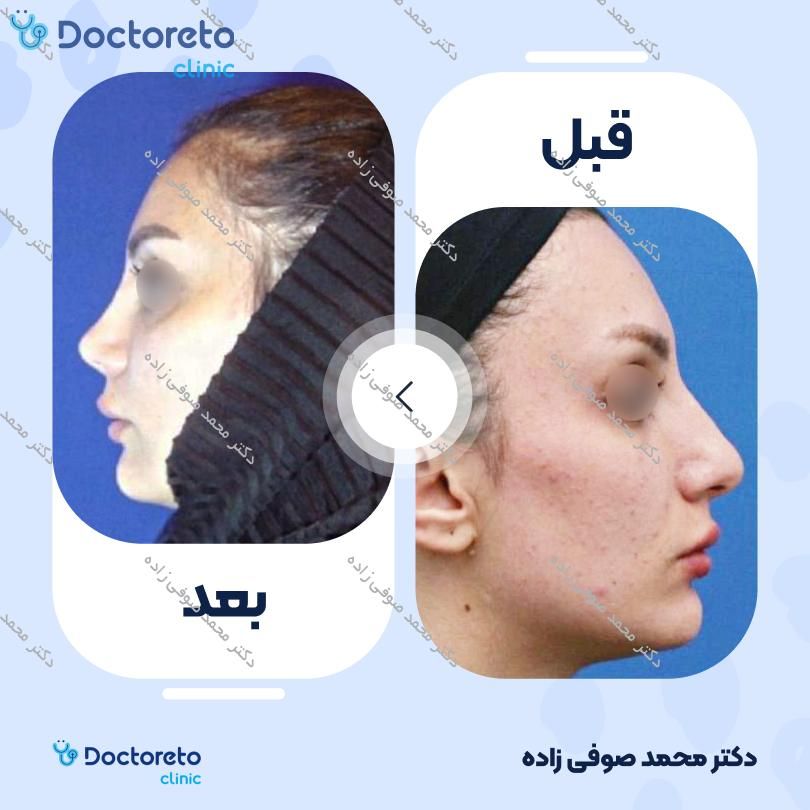 عمل زیبایی بینی (رینوپلاستی) دکتر محمد صوفی زاده در تهران 34