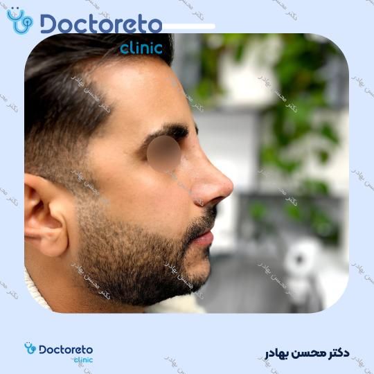 عمل جراحی مجدد زیبایی بینی (رینوپلاستی) دکتر محسن بهادر در شیراز 14