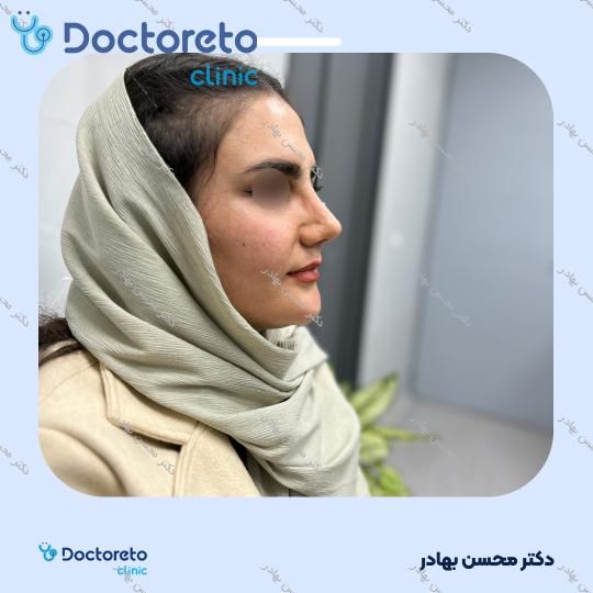 جراحی انحراف بینی (سپتوپلاستی) دکتر محسن بهادر در مرودشت 16