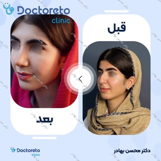 جراحی انحراف بینی (سپتوپلاستی) دکتر محسن بهادر در مرودشت 3