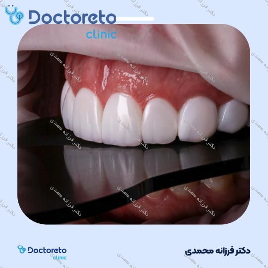 ونیر کامپوزیت توکویاما ژاپنی (هر واحد) دکتر فرزانه محمدی در شیراز 15