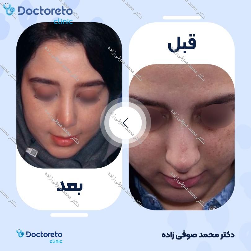 عمل زیبایی بینی (رینوپلاستی) دکتر محمد صوفی زاده در تهران 22