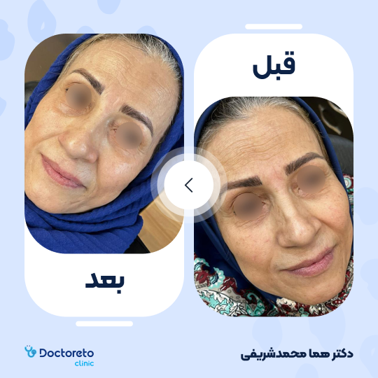 جوانسازی صورت با پلاسما تراپی (هرجلسه)