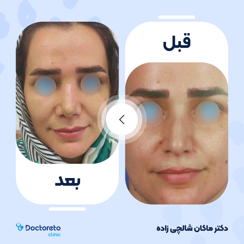 عمل جراحی مجدد زیبایی بینی (رینوپلاستی) دکتر ماکان شالچی زاده در فومن 10