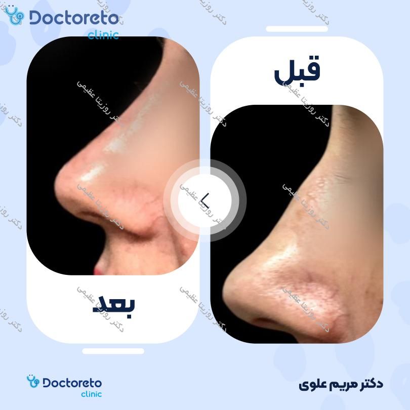 تزریق ژل بینی با برند نوکسیول (1CC)