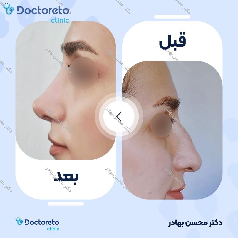 جراحی انحراف بینی (سپتوپلاستی) دکتر محسن بهادر در مرودشت 8