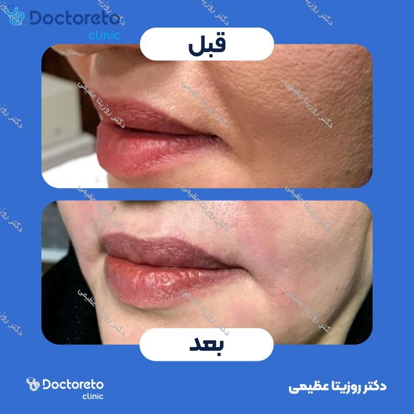 تزریق ژل خط خنده با برند رووفیل (1CC)