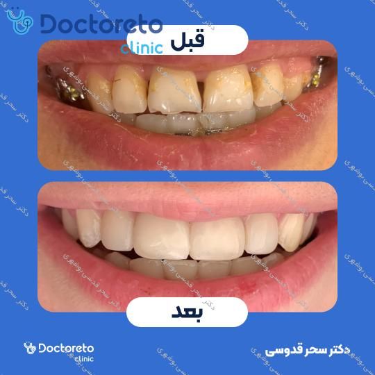 ونیر کامپوزیت توکویاما ژاپنی (هر واحد)