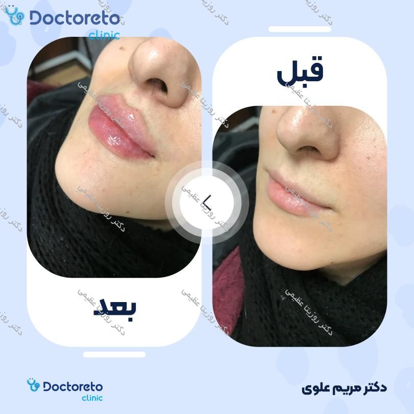 تزریق ژل لب با برند اینووسنس (1CC)