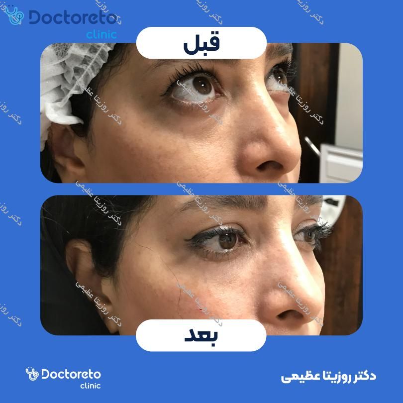 تزریق ژل زیرچشم با برند فیوریج (1CC)