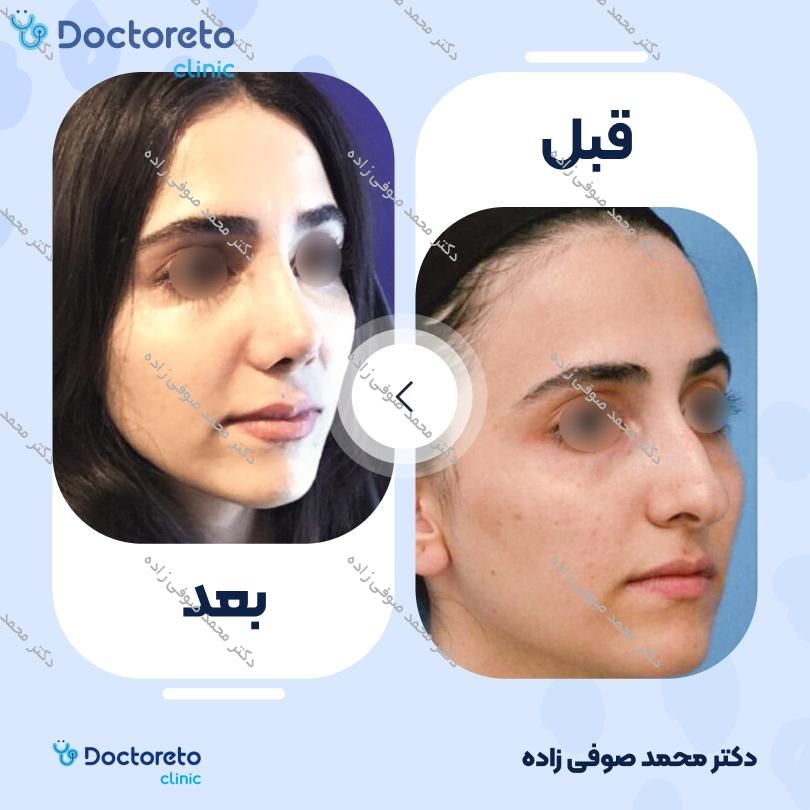عمل زیبایی بینی (رینوپلاستی) دکتر محمد صوفی زاده در تهران 30