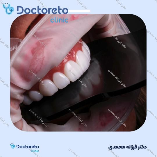 ونیر کامپوزیت توکویاما ژاپنی (هر واحد) دکتر فرزانه محمدی در شیراز 13
