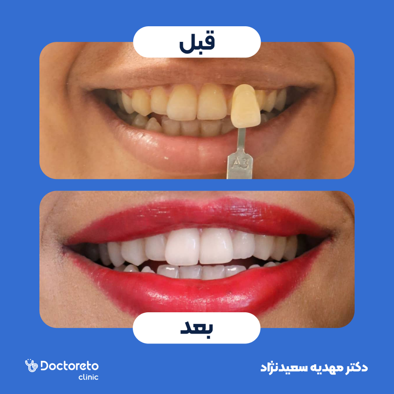 آفیس بلیچینگ با مواد الترادنت آمریکایی (هر فک) دکتر مهدیه سعیدنژاد در تهران 4