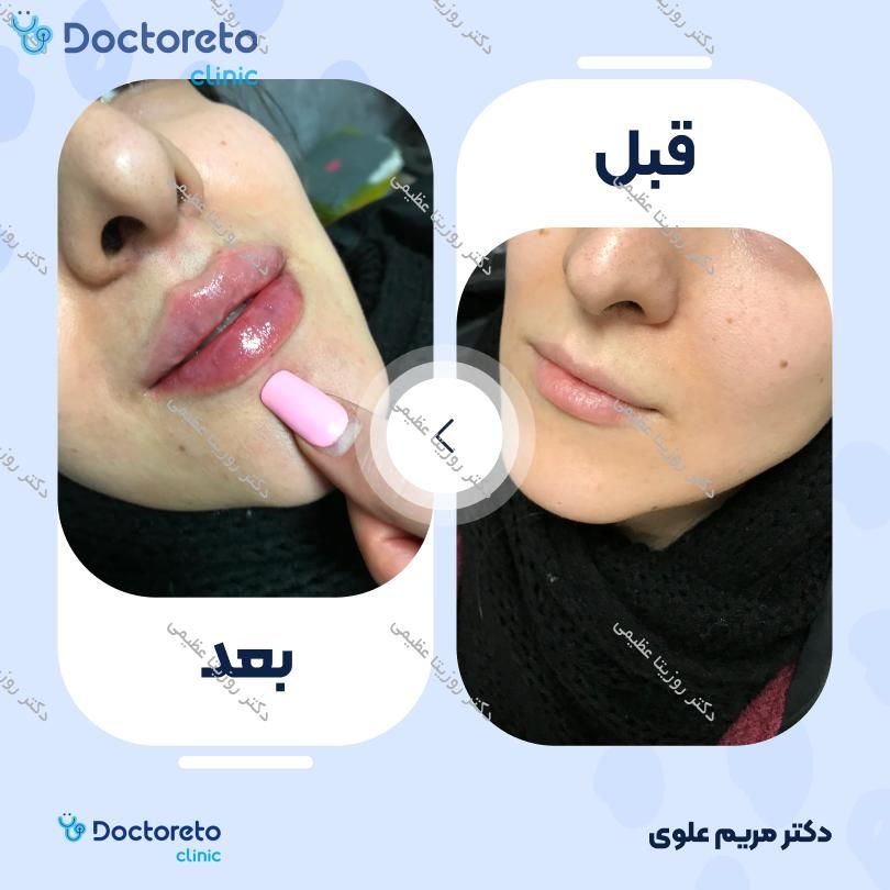 تزریق ژل لب با برند ساردینا (1CC)