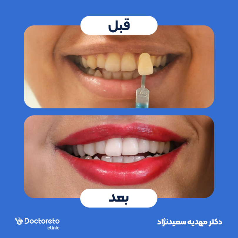 آفیس بلیچینگ با مواد وایت اسمایل آلمانی (هر فک)
