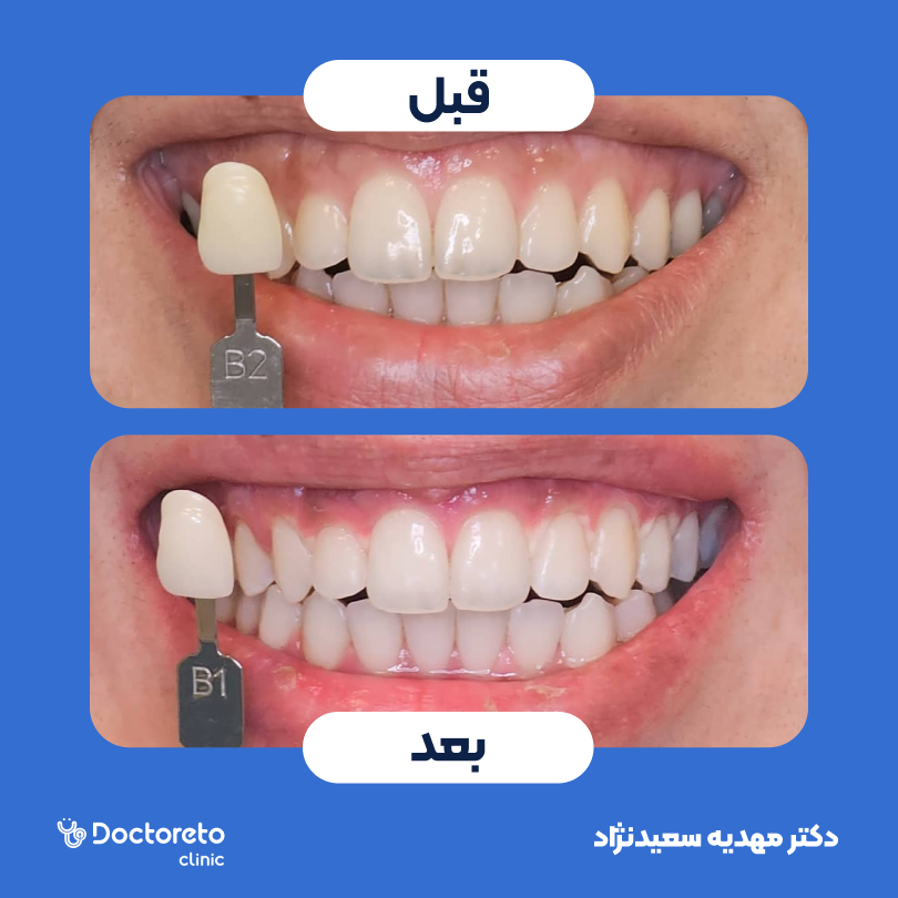 آفیس بلیچینگ با مواد وایت اسمایل آلمانی (هر فک) دکتر مهدیه سعیدنژاد در تهران 4