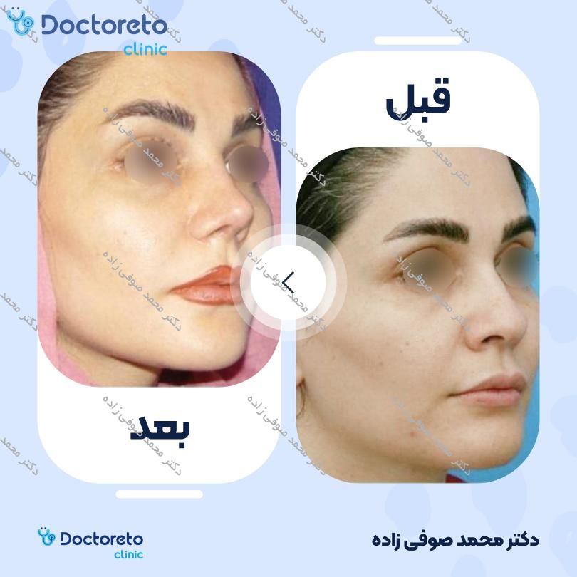 عمل زیبایی بینی (رینوپلاستی) دکتر محمد صوفی زاده در تهران 2