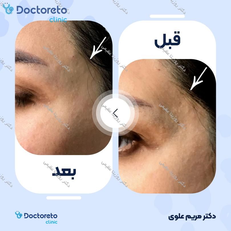 تزریق ژل شقیقه با برند eptq (هر cc)