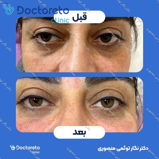 تزریق ژل زیر چشم با برند استایلج (1CC)