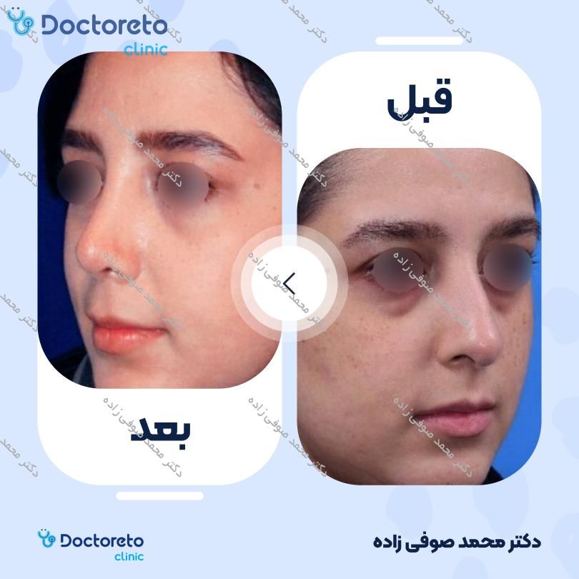 عمل زیبایی بینی (رینوپلاستی) دکتر محمد صوفی زاده در تهران 21