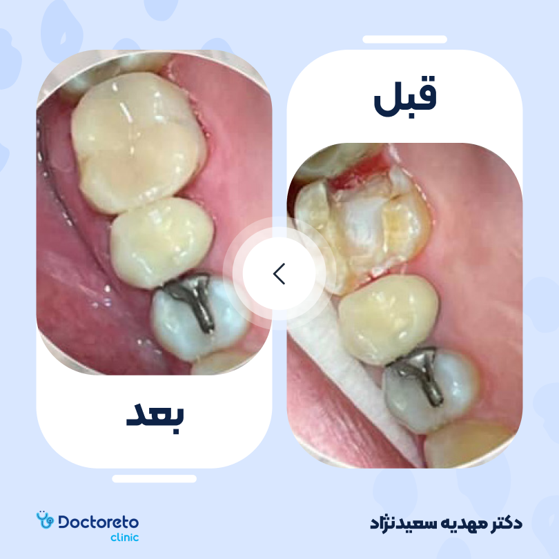 پرکردن دندان سه سطحی با کامپوزیت آمریکایی دکتر مهدیه سعیدنژاد در تهران 3