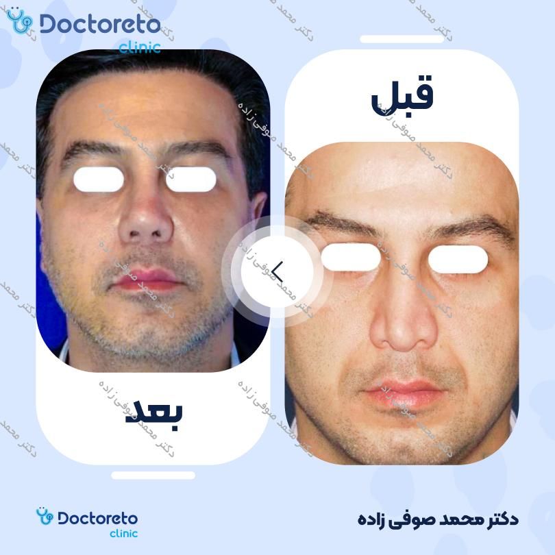 عمل زیبایی بینی (رینوپلاستی) دکتر محمد صوفی زاده در تهران 26