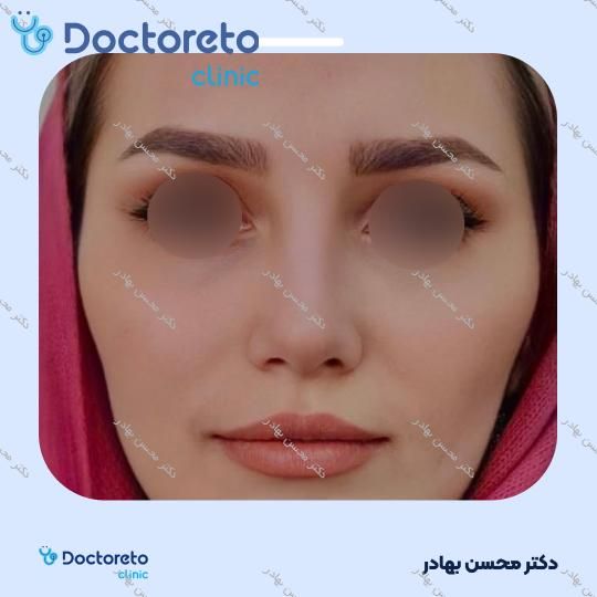 جراحی انحراف بینی (سپتوپلاستی) دکتر محسن بهادر در مرودشت 10