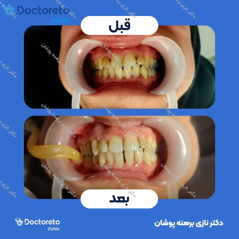 جرم گیری هر فک با بروساژ