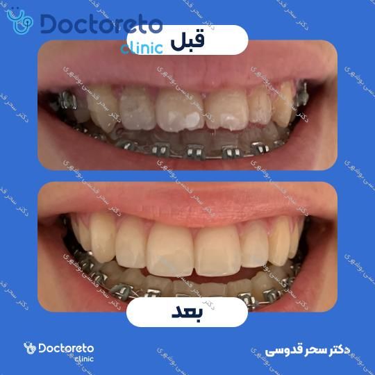 ونیر کامپوزیت توکویاما ژاپنی (هر واحد)