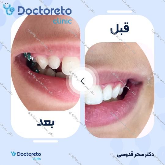 ونیر کامپوزیت توکویاما ژاپنی (هر واحد)