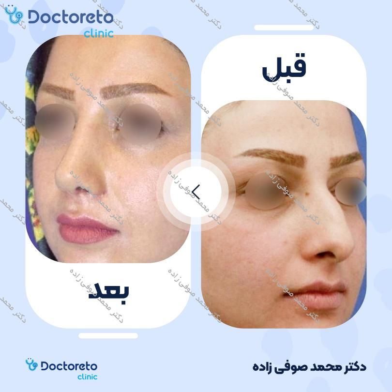 عمل جراحی مجدد زیبایی بینی (رینوپلاستی) دکتر محمد صوفی زاده در تهران 19