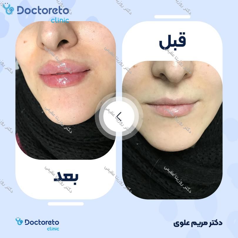 تزریق ژل لب با برند لوناژل (1CC)