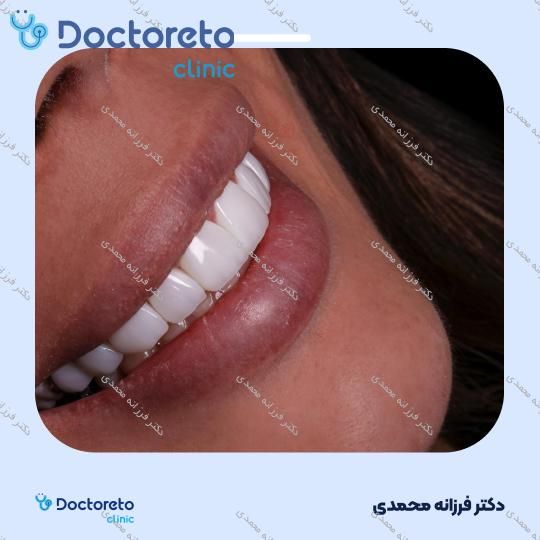 ونیر کامپوزیت سارمکو سوئیسی (هر واحد)
