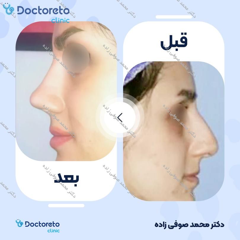 عمل زیبایی بینی (رینوپلاستی) دکتر محمد صوفی زاده در تهران 8
