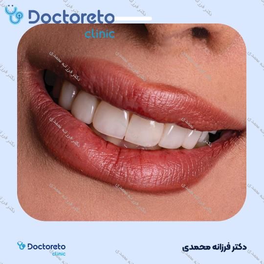 ونیر کامپوزیت توکویاما ژاپنی (هر واحد) دکتر فرزانه محمدی در شیراز 7