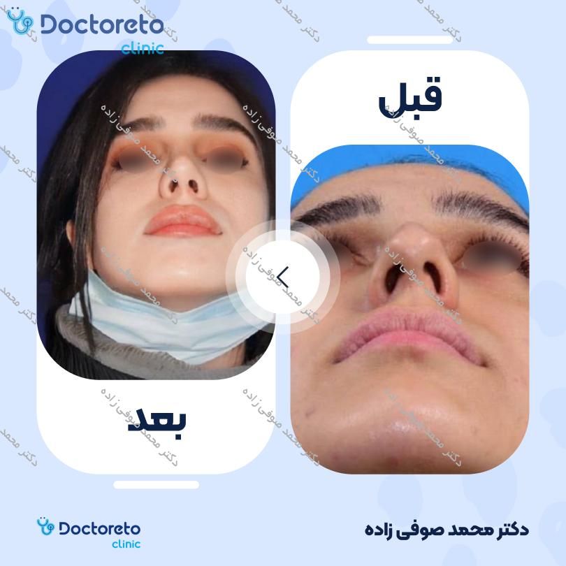 عمل زیبایی بینی (رینوپلاستی) دکتر محمد صوفی زاده در تهران 40