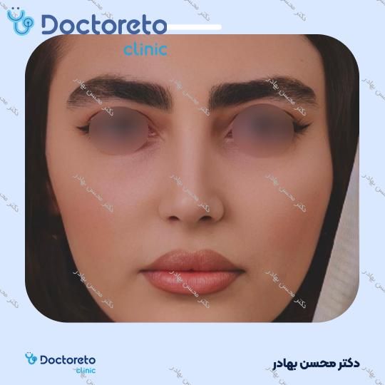 جراحی انحراف بینی (سپتوپلاستی) دکتر محسن بهادر در مرودشت 11