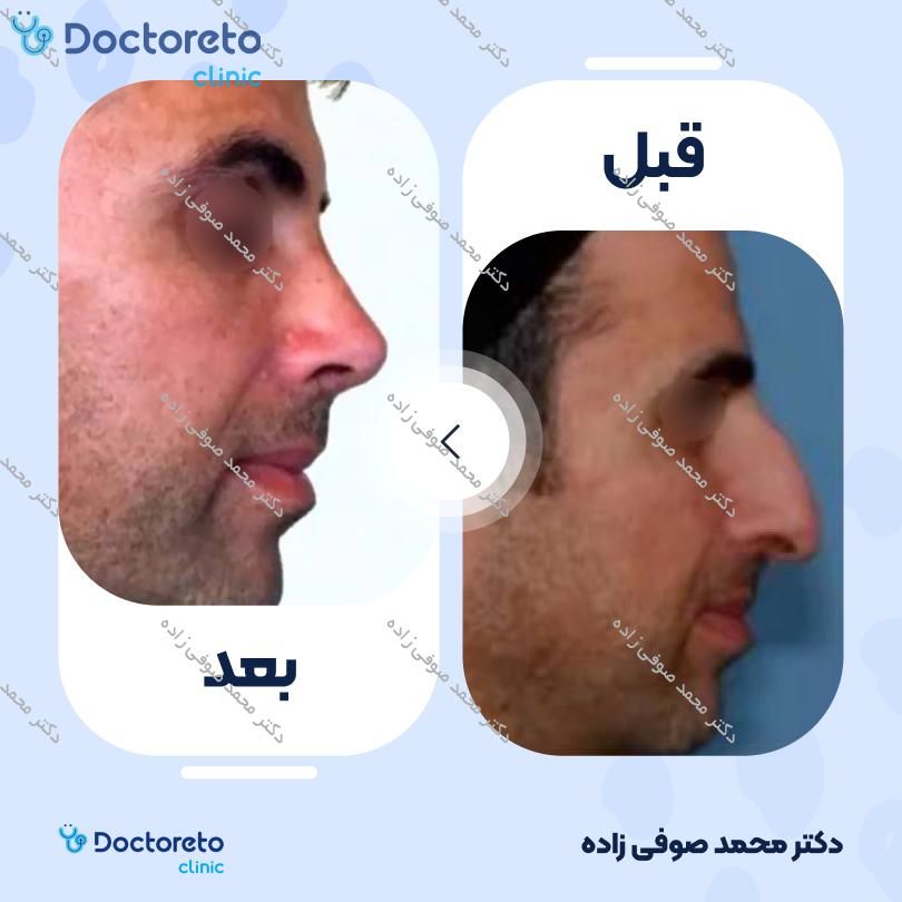 عمل زیبایی بینی (رینوپلاستی) دکتر محمد صوفی زاده در تهران 7