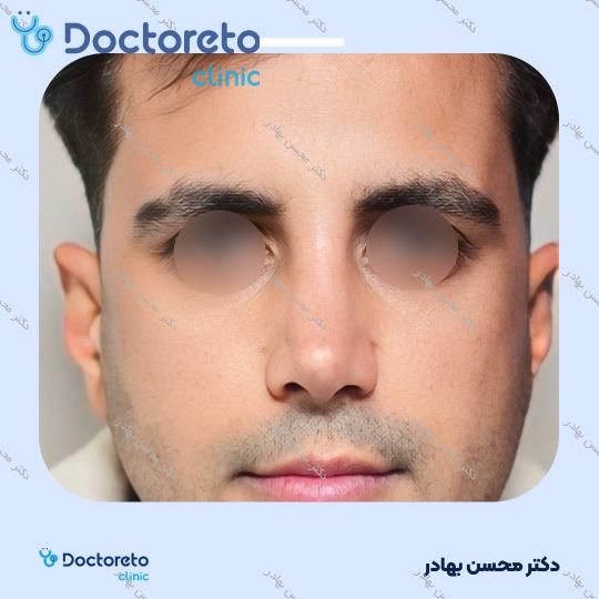 جراحی انحراف بینی (سپتوپلاستی) دکتر محسن بهادر در مرودشت 15