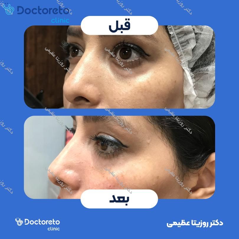 تزریق ژل زیرچشم با برند فیوریج (1CC)