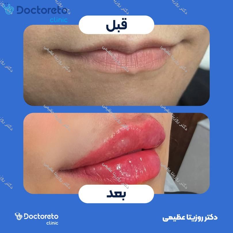 تزریق ژل لب با برند نورامیس (1CC)
