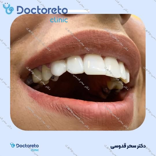 ونیر کامپوزیت توکویاما ژاپنی (هر واحد)